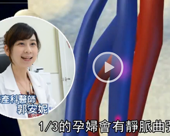 【蘋果日報】想不到這裡也會靜脈曲張!又腫又痛