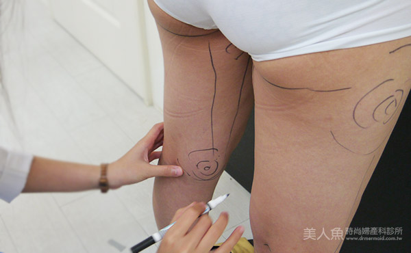 自體脂肪豐胸