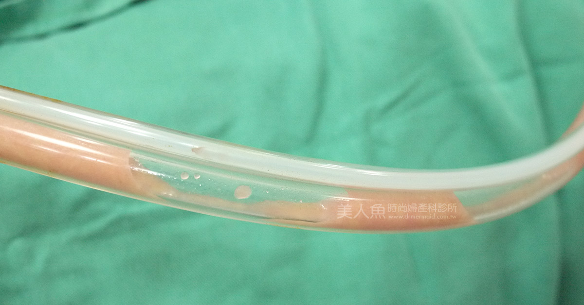 抽脂瘦大腿