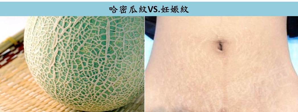 妊娠紋