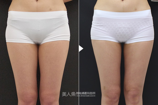 瘦大腿