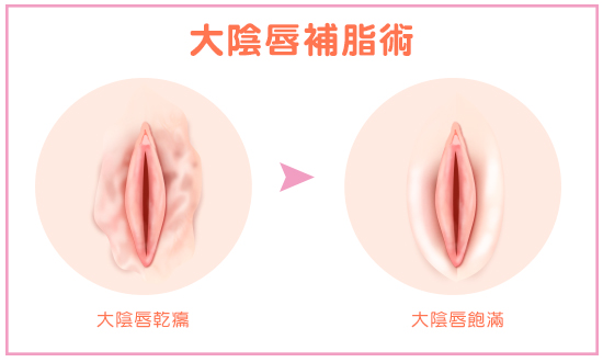 大陰唇手術
