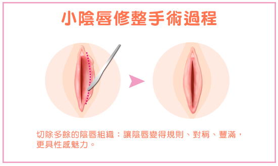 小陰唇修整手術